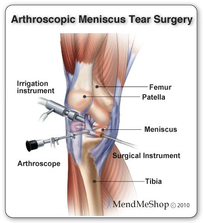 arthroscopic meniscal tear surgery