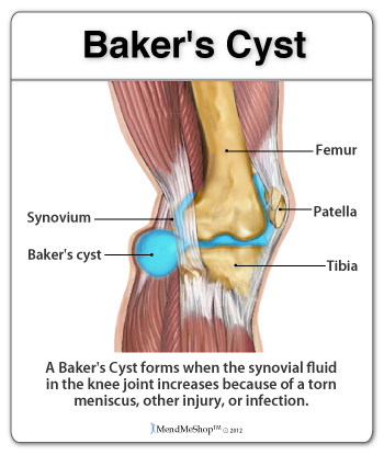 Baker's cysts can form on the back of the knee.