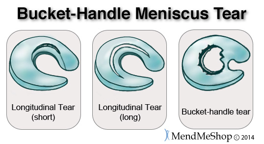medical meniscus bucket handle tear