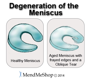 Degeneration posterior horn meniscus tear