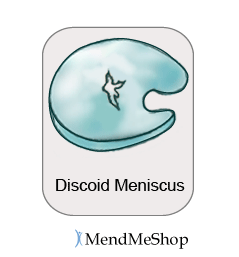 Discoid meniscus tear