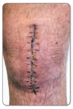 open knee surgery suture