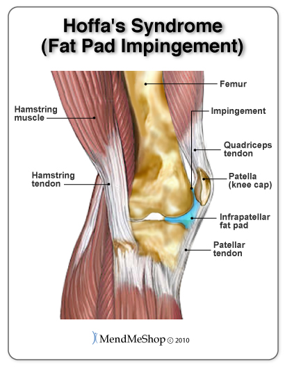 knee tendonitis pain regions