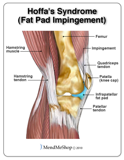 Quadriceps Tendinosis  can cause pain at the front of the knee 