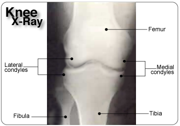 X-ray of the knee