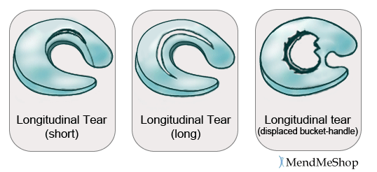 Longitudinal tears and more severe displaced bucket handle tear