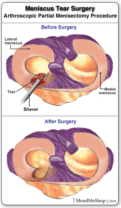 meniscus repair surgery recovery