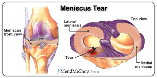 Meniscus tear