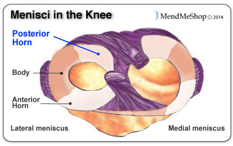 posterior horn meniscal tear