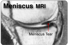 Posterior Horn meniscus mri