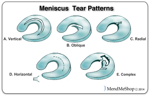 5 types of meniscal tear patterns, lateral and medial meniscus