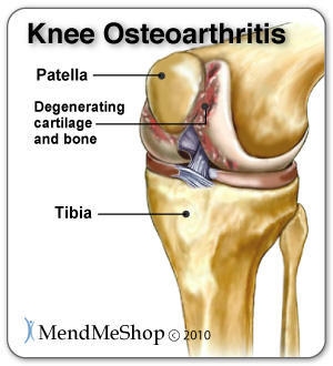 Wear and tear over time can form degenerative meniscus tear