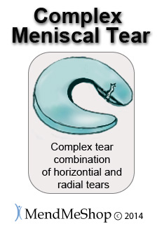 Complex tear posterior horn meniscal tear