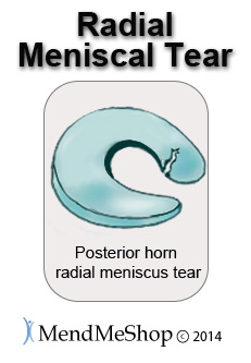 Radial tear posterior horn medial meniscus